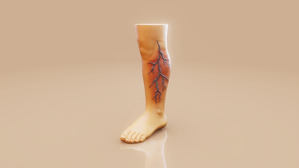 Varicose Veins Treatment