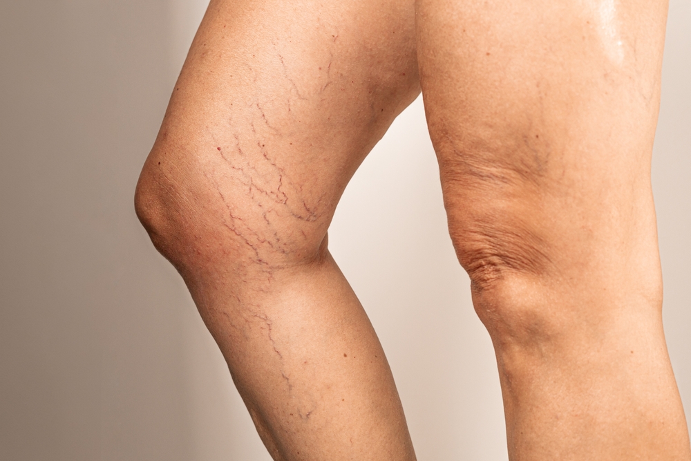 DVT Treatment