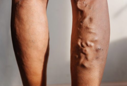 Varicose,Veins,In,A,Woman.,Swelling,Of,Veins,In,The