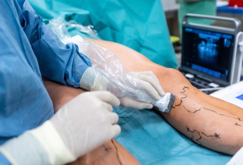 Process,Of,Varicose,Vein,Surgery,In,Hospital,,Operating,Room,,Vein